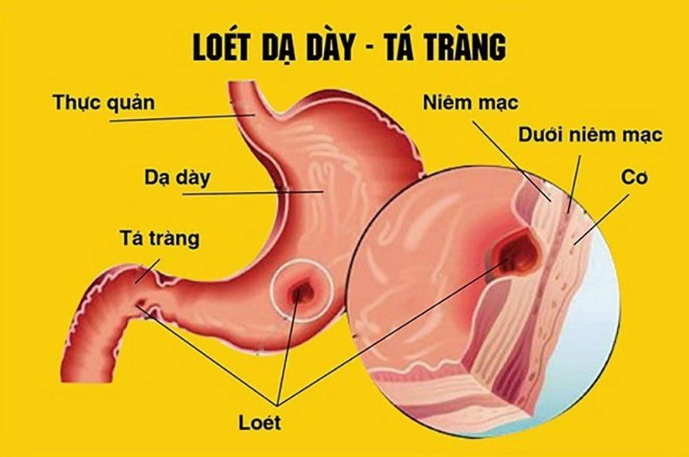 Viêm loét dạ dày nên ăn gì? Bí quyết giúp giảm đau hiệu quả